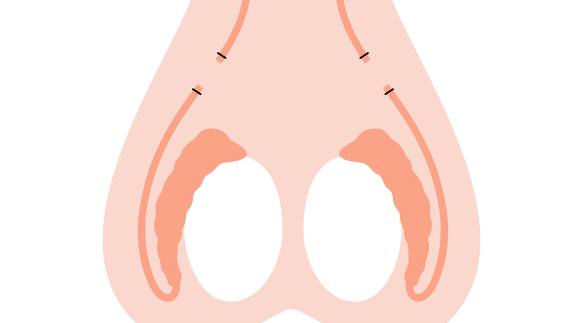 Vasectomia
